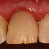 stav po vnitřním bělení zubů
