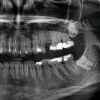 Panoramatický rentgen