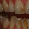 pískování zubů - stav před ošetřením
