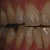 pískování zubů - po ošetření