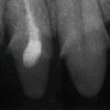 Unvollkommen endodontisch behandelter Zahn